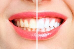 Teeth whitening questions to ask from dentist
